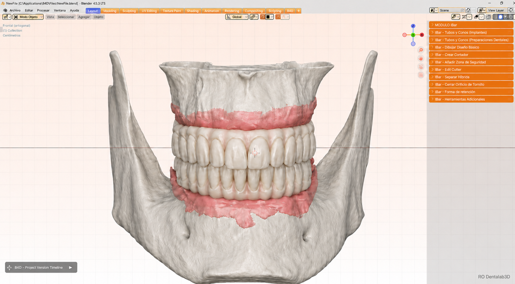 Diseño digital de rehabilitación bimaxilar sobre anatomía ósea